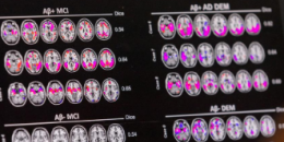 科学家称拥有两个风险基因拷贝的人患有阿尔茨海默氏症的遗传形式