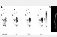 新型PET药物为透明细胞肾细胞癌患者提供卓越的当日成像