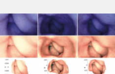 结肠的新3D模型可帮助更快地检测疾病
